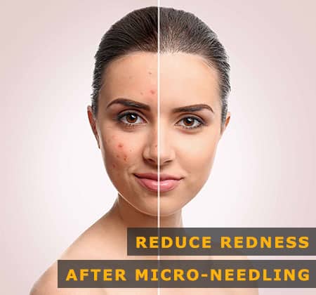 Featured Image of Reduce Redness After Micro-needling